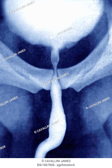 Normal masculine ureter, visualized by urography of the pelvis in front view