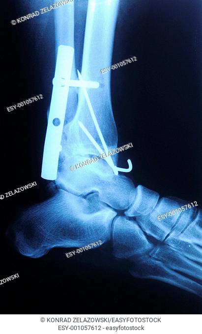 authentic x-ray picture of human fracture ankle with metal plate and screws