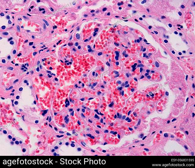 Diseased kidney showing glomerular and peritubular congestion. The glomerular capillaries appear very dilated and full of red blood cells