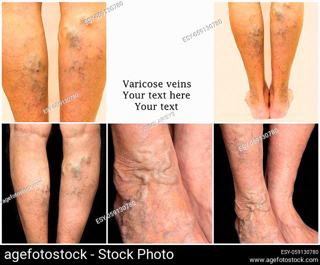 The varicose veins on a legs of old woman. Collage with copy space