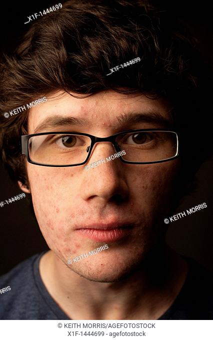 a spotty faced young man teenager youth with acne bad skin complexion wearing glasses nerd geek geeky young adult male, UK