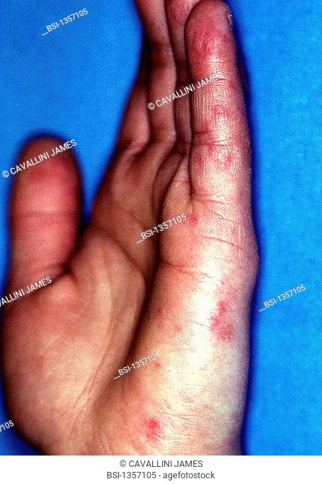 LUPUS ERYTHEMATOSUS<BR>Lupus erythematosus of the hand