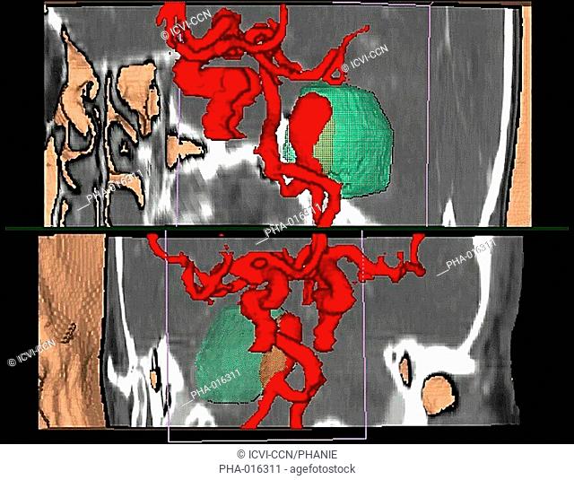 Three-dimensional computed tomographic CT scan reconstruction of an intracranial aneurysm located on the basilar artery red ballon shaped swelling partially...