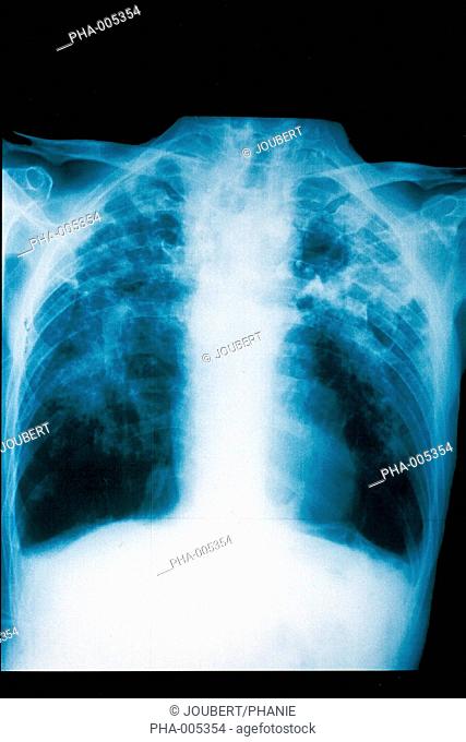 Lung X-ray Occupational disease Pneumoconiosis/Silicosis