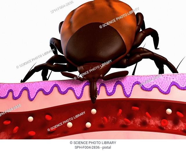 Tick feeding. Computer artwork of a tick superfamily Ixodoidea feeding, showing a cross-section through skin