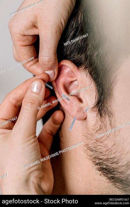 Traditional Chinese Medicine, TCM, acupuncture, ear with acupuncture needle during treatment