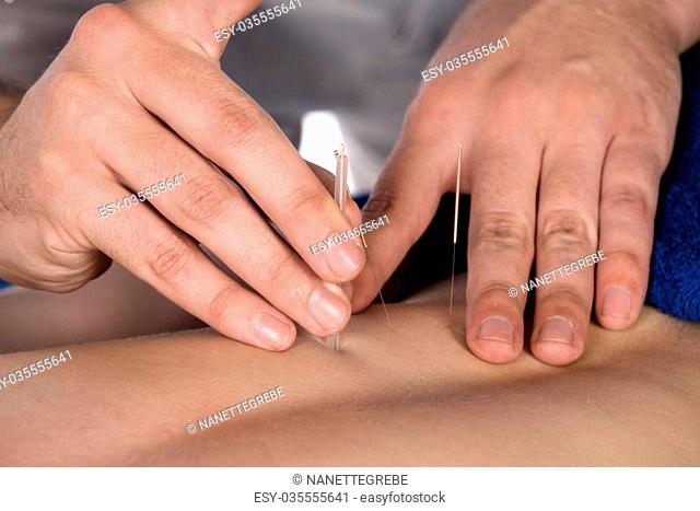 Adult male physiotherapist is doing acupuncture on the back of a female patient. Patient is lying down on a bed and is covered with royal blue towels
