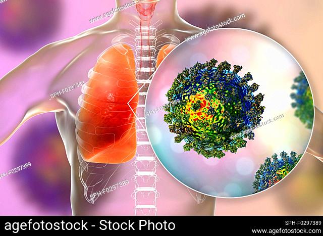 Coronavirus disease of the lungs, conceptual illustration