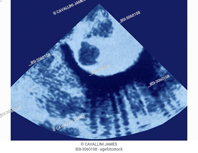 Vascular embolism by the presence of a thrombus in the aortic arch - Cardiac ultrasound