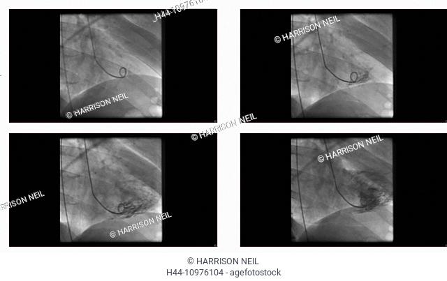 Angiogram sequence working clockwise using x-rays with a contrast agent injected from a tube inserted into the arteries (left & centre)