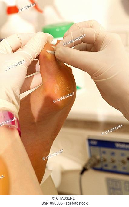 PEDICURE<BR>Photo essay in podology consultation.<BR>Pedicure. Removal of a foot callus