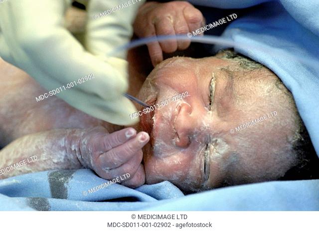 A gloved hand place a small suction into the mouth of a new born child, to remove unwanted mucus from the child's mouth