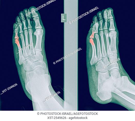 x-ray of a foot showing a fracture in the intermediate phalanx of the small toe on the left foot of a 30 year old male patient
