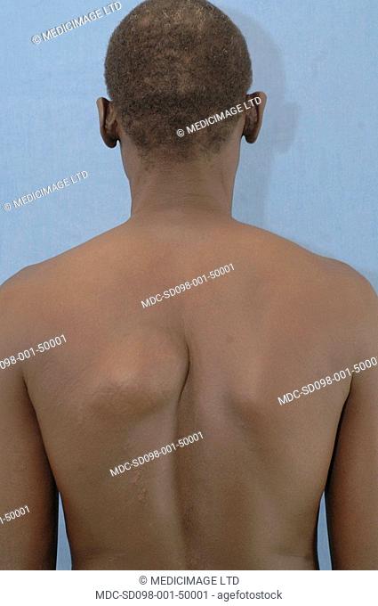 The patient has back lipoma, a benign tumour composed of fatty tissue and generally painless./nSuch tumors can also appear in various body organs