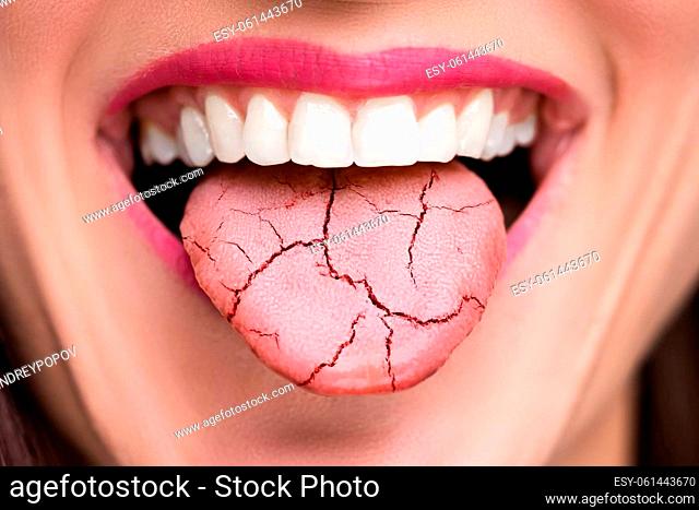 Dry Tongue Pain And Cracks. Oral Candidiasis
