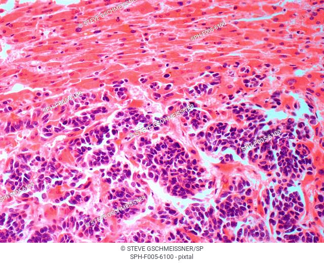 Secondary liver cancer. Light micrograph of a section through liver tissue showing a secondary cancer that had metastasised spread from a primary small cell...