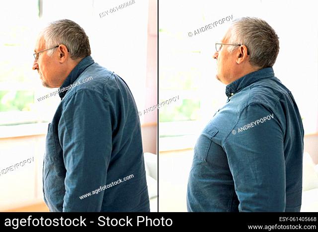 Man With Lordosis And Normal Curvature Against Gray Background