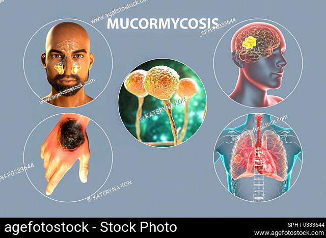 Clinical forms of mucormycosis, illustration