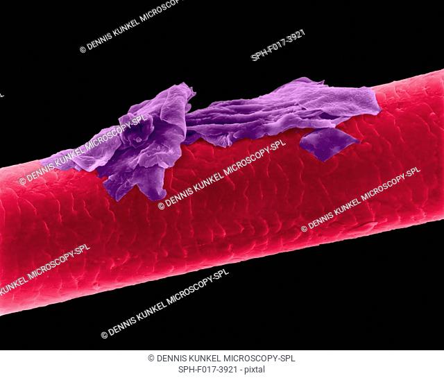 Human hair with dandruff, coloured scanning electron micrograph (SEM). The outer layer of hair (the cuticle) has overlapping scales of keratin