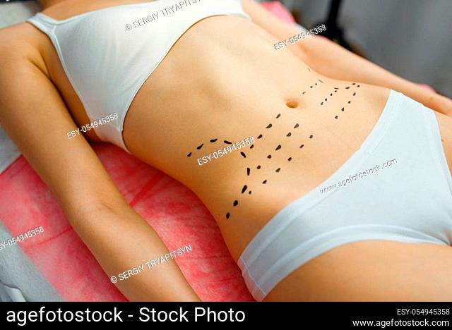 Female patient with markers on her abdomen lying on treatment table in cosmetician's office. Rejuvenation procedure in beautician salon