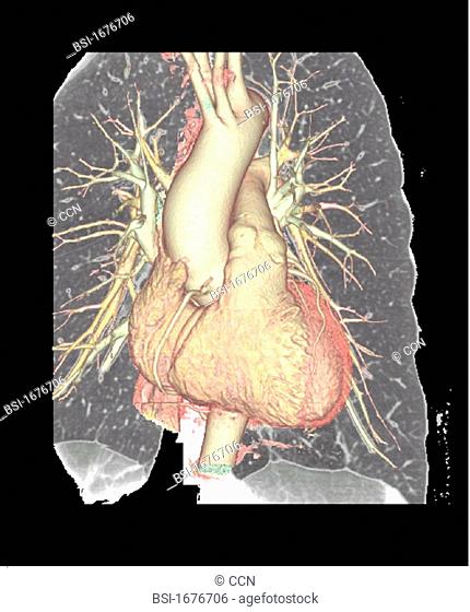 HEART, 3D SCAN Angiography scanner 3D. Visualization of the heart, aortic arch and pulmonary vascularization arteries and arterioles
