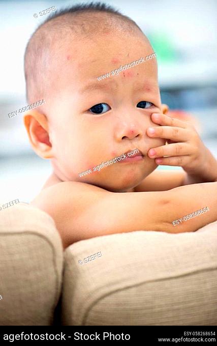 Asian baby sitting on couch with chicken pox rash, natural photo