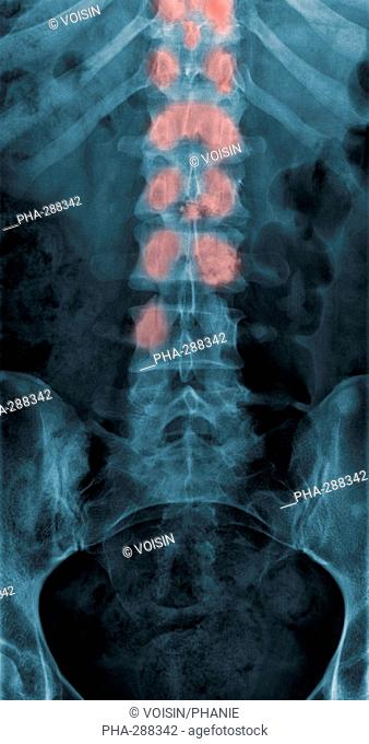 X-ray showing a spine with malignant tumours (pink) which have metastasised from a primary cancer of the breast