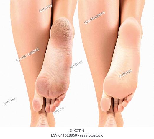 Female feet with dry skin and cracks before and after treatment and spa. Isolated on white background