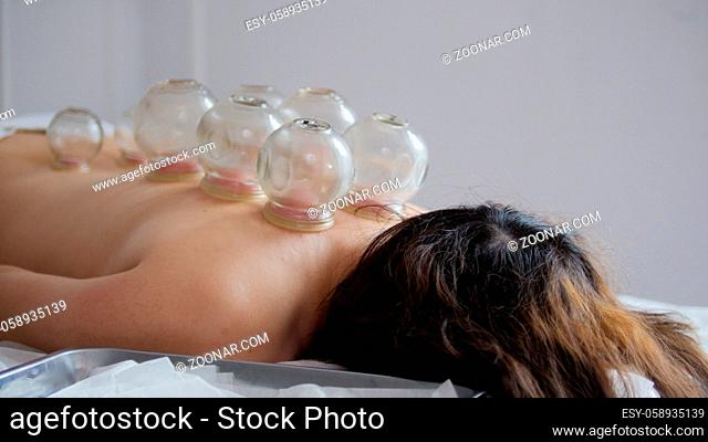 Tibetan medicine - a lot of glass cup on the back of a woman, close up