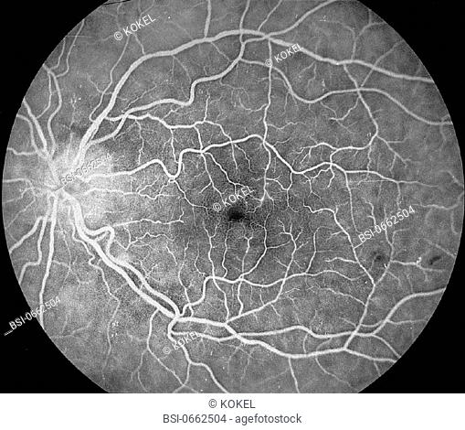 RETINA, ANGIOGRAPHY<BR>Retinal vascularity, with dilated and porous capillary network. Fluorescein angiography of the retina