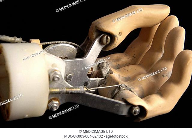 Cable operated prosthetic hand. The cable operated hand works by attaching a harness and cable around the opposite shoulder of the damaged arm