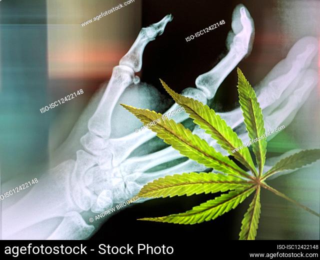 Cannabis leaf and bonescan as potential curation for arthritus