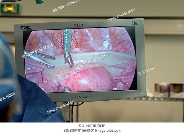 Reportage in the gynecology surgery theater in Lenval Clinic, Nice, France. Removal of an ovarian endometrium (endometriosis that forms a cyst in the ovary) by...