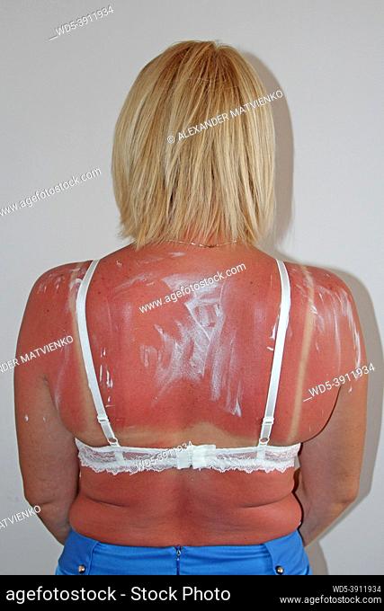 Sunburn from beach sun light on shoulder and back of caucacian girl. Woman sunburn. Female body. Body care. Sunburn on female back