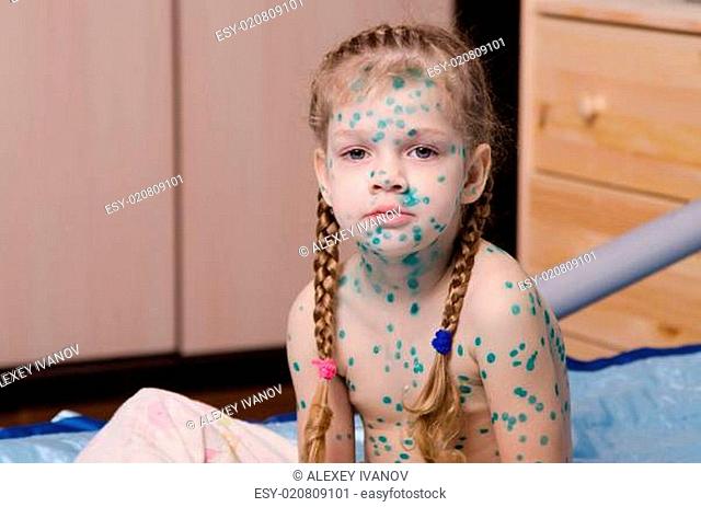 The little girl suffering from chicken pox all smeared zelenkoj