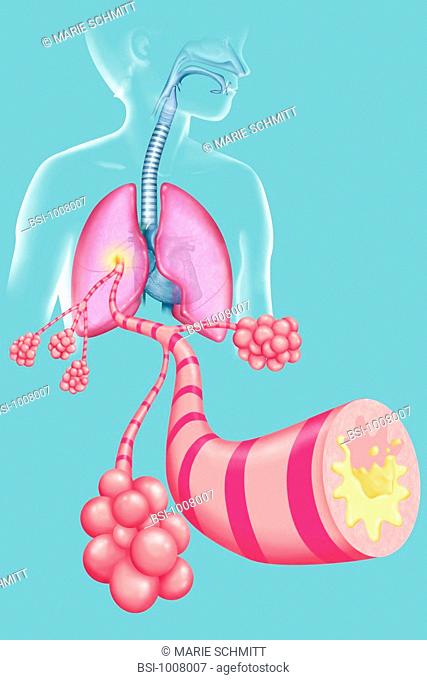 BRONCHITIS, DRAWING Child bronchitis. See images 0845407 and 0845307 for adult bronchitis
