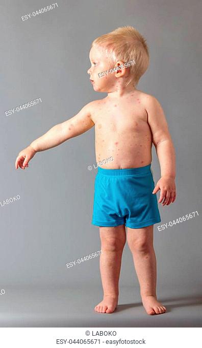On the body of small boy rash from chickenpox, on gray background