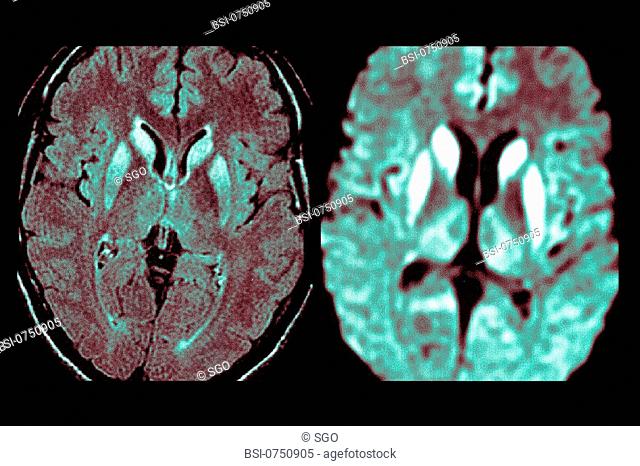 CREUTZFELDT JAKOB DISEASE, MRI<BR>Bilateral lesions of the caudate heads, the putamens, and the internal posterior region of the two thalami (image on the...