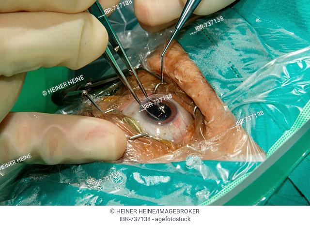 Cataract surgery performed in an operating room in Pietermaritzburg, South Africa, Africa