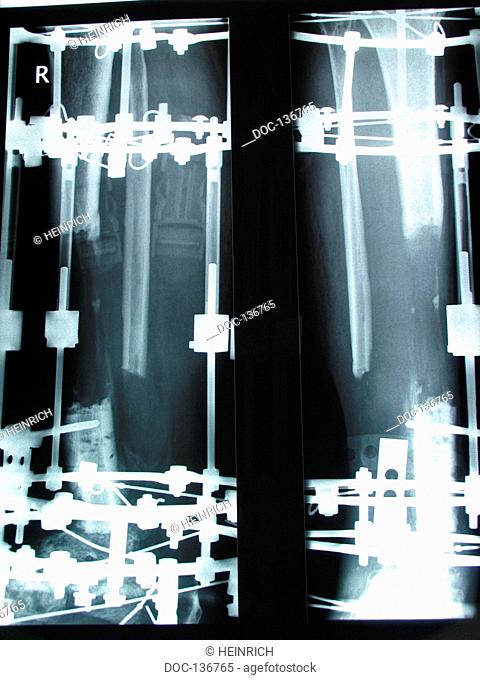 x-ray - shinbone fracture tibia