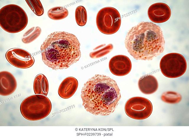 Eosinophilia, blood smear with numerous eosinophils, computer illustration. Eosinophils, like all white blood cells, are part of the immune system