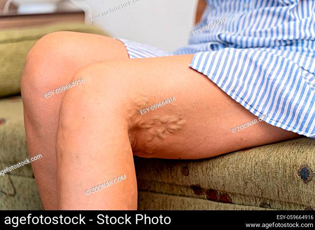 Woman at home with varicose veins. Healthcare problem, thrombophlebitis issue. High quality 4k footage