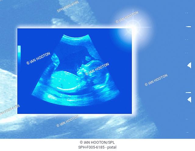 20-week baby ultrasound scan