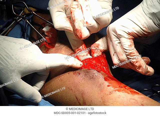 Close up of surgeons performing an Axillary Artery Aneurysm to a repair on the arm of a teenage boy after a stab wound to the shoulder
