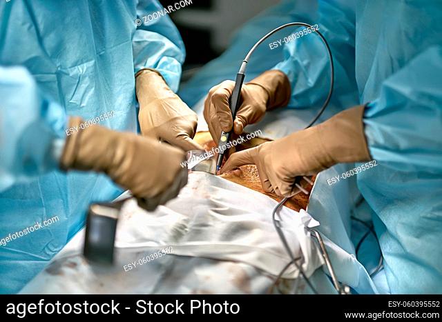 Surgeon is using a laser scalpel while assistant is holding a surgical retractor during the abdominal operation. Patient's stomach covered with iodine