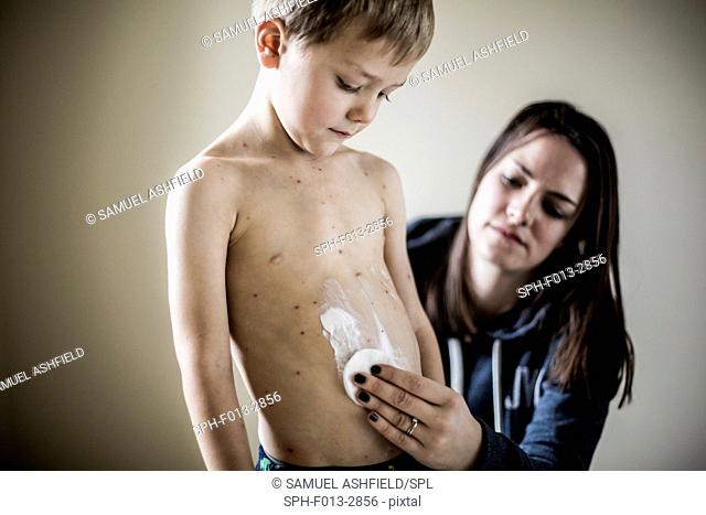 Mother applying cream to son with chickenpox