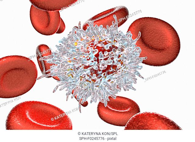 Hairy cell leukaemia. Computer illustration of an abnormal white blood cell (B- lymphocyte) from a patient with hairy cell leukaemia