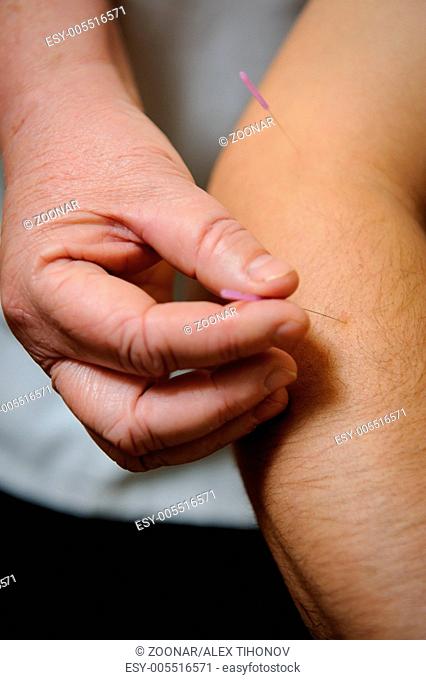 Acupuncture. Needles being inserted into a patient's skin