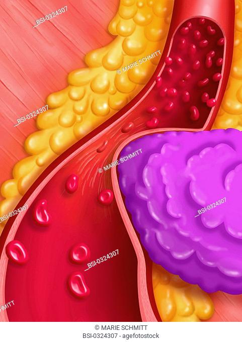Blood circulation in a stenosed artery caused by the compression of a tumor. Here, example of a coronary artery. This image is part of a series on vascular...