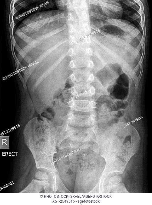 Abdomen x-ray of a standing 5 year old male child